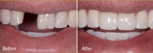 Dental Implants Leicester